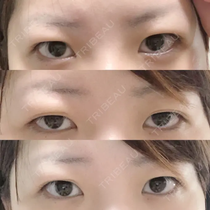 眼瞼下垂（切開） / 上まぶたの脂肪取り なでしこクリニック BEFORE メイン用