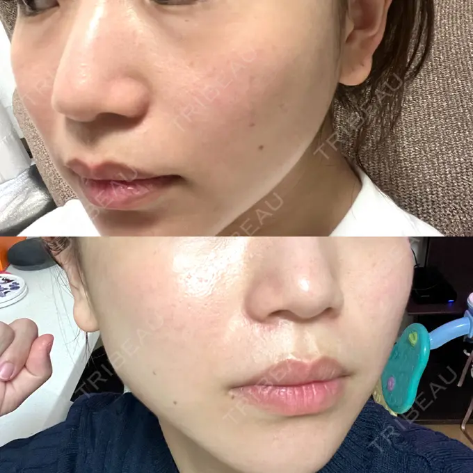 ピーリング（ニキビ・毛穴） 東京素肌クリニック 銀座本院 BEFORE メイン用