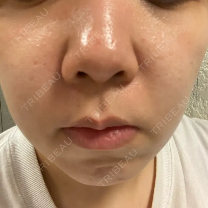 肌ヒアルロン酸注入（たるみ・シワ改善） / サブシジョン / ピコレーザートーニング（美白・肝斑） 東京シルククリニック 東京神田院 BEFORE メイン用