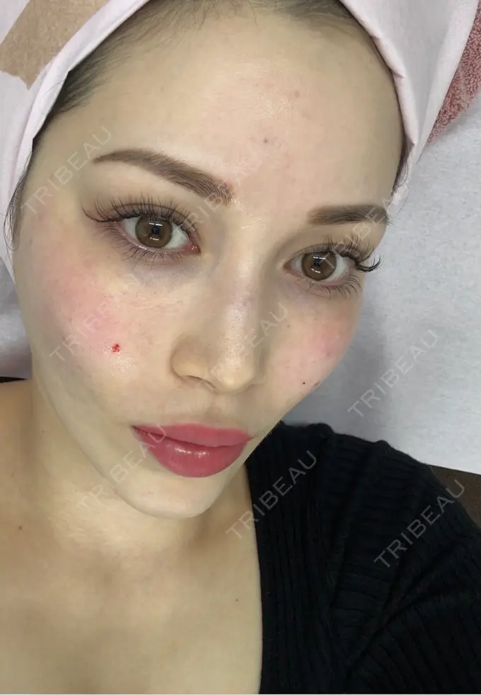 ボトックス（眉間） / 肌育注射（ジュベルックなど） / その他（肌） ルラ美容クリニック 渋谷本院 BEFORE メイン用