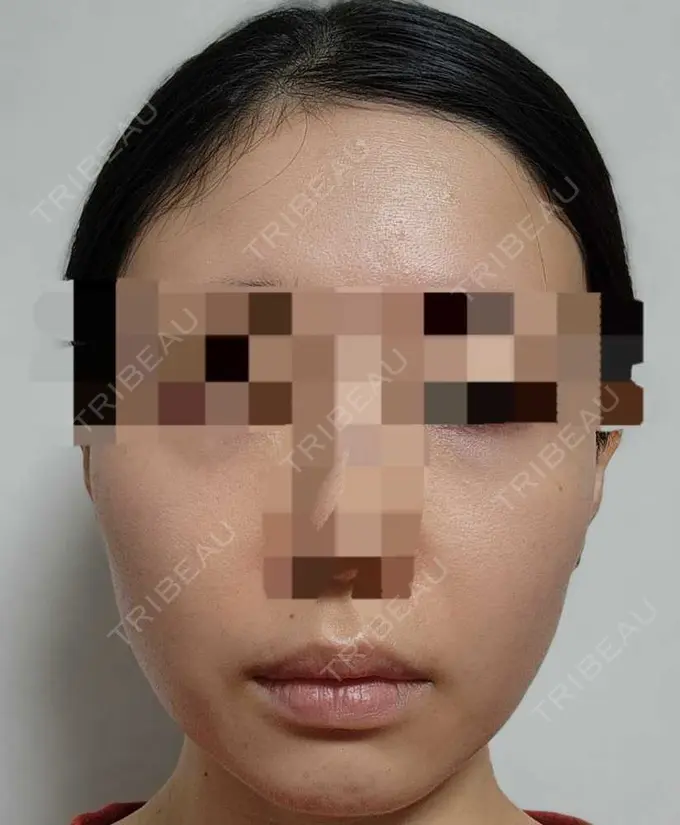 ボトックス（エラ・小顔） L‘amour clinic Tokyo【ラムールクリニック東京】 BEFORE メイン用