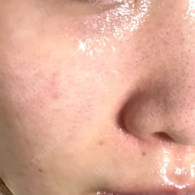 ダーマペン 心斎橋KT美容クリニック BEFORE メイン用