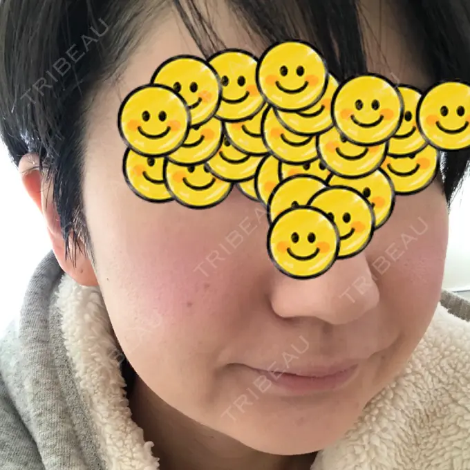 バッカルファット除去 / 脂肪吸引（顔） ジョウクリニック 大阪院 BEFORE メイン用