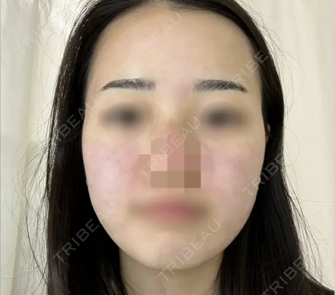 糸リフト / バッカルファット除去 / 脂肪吸引（顔） / ヒアルロン酸注入（あご） / ボトックス（エラ・小顔） RIVER CLINIC（リバークリニック） BEFORE メイン用