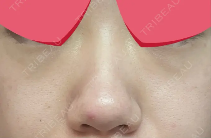鼻尖形成（切開） / 下まぶたの脂肪取り / 真皮移植 LUHO（ルホ）美容外科 BEFORE メイン用