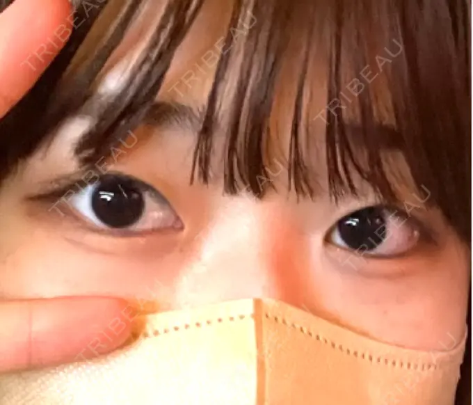 二重埋没 水の森美容クリニック 東京銀座院 BEFORE メイン用