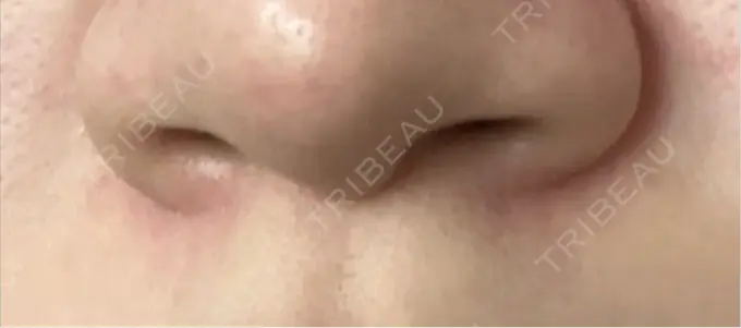 小鼻縮小（切開） / ボトックス（エラ・小顔） / ヒアルロン酸注入（鼻翼基部） eクリニック 福岡院 BEFORE メイン用