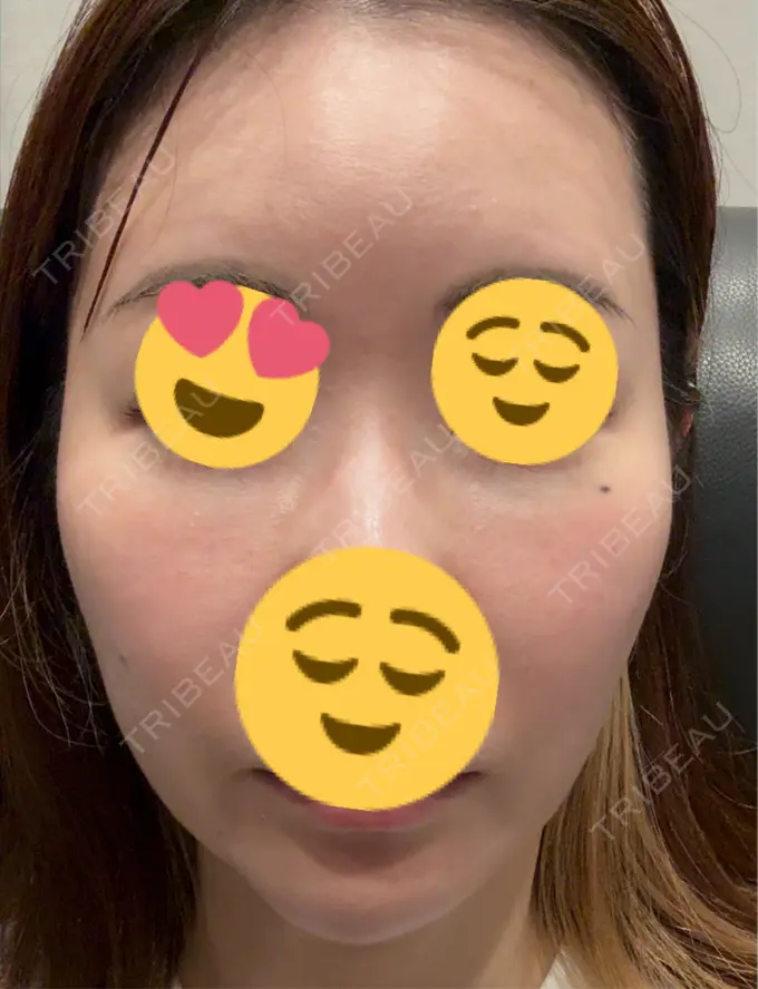 水光注射（ハリ・美肌） / PRP皮膚再生療法 筋肉・美容クリニック BEFORE メイン用