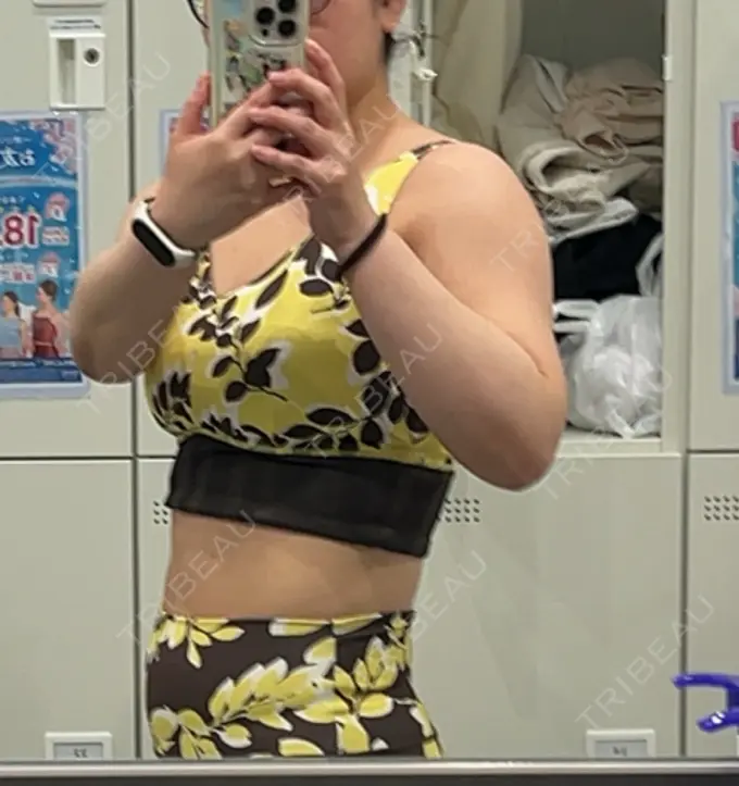 脂肪溶解注射（二の腕） Natural Skin Clinic 笹塚院 BEFORE メイン用