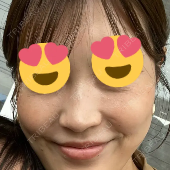 水光注射（ハリ・美肌） 筋肉・美容クリニック BEFORE メイン用