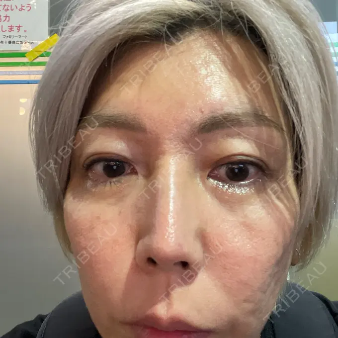 アートメイク（アイライン） 筋肉・美容クリニック BEFORE メイン用