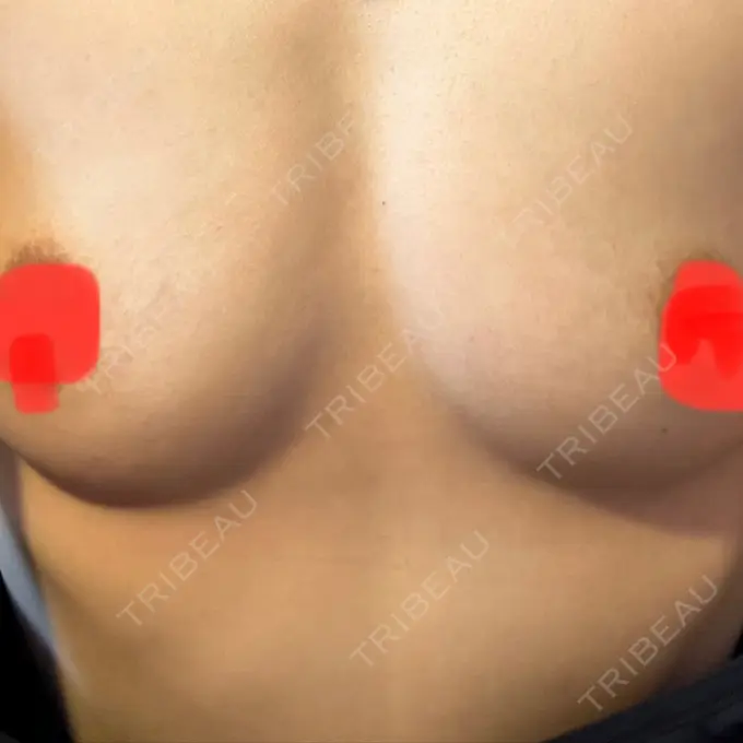 脂肪吸引（二の腕） / 豊胸（シリコンバッグ） / その他（胸） お茶の水美容形成クリニック BEFORE メイン用