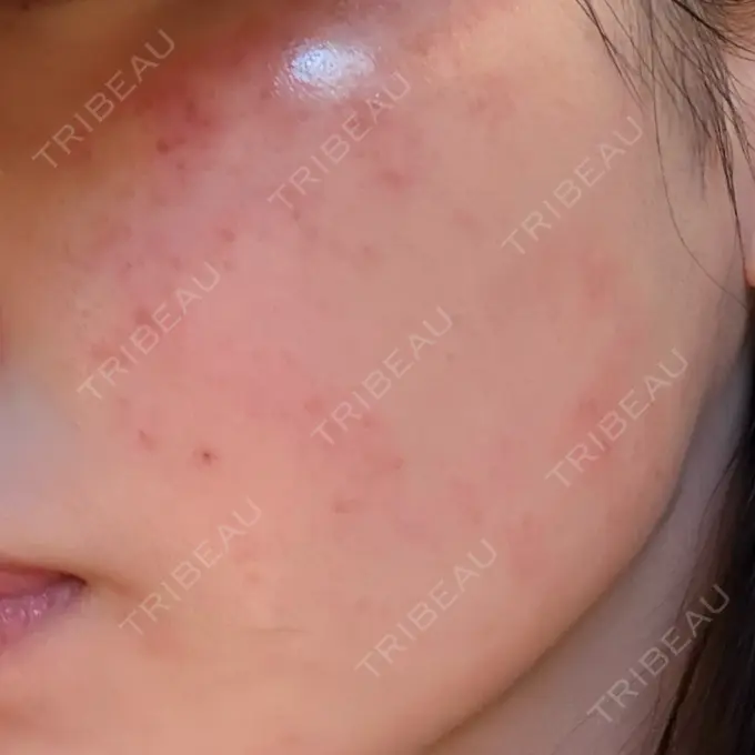 ピコフラクショナルレーザー（毛穴・ニキビ跡） 麹町皮ふ科・形成外科クリニック BEFORE メイン用