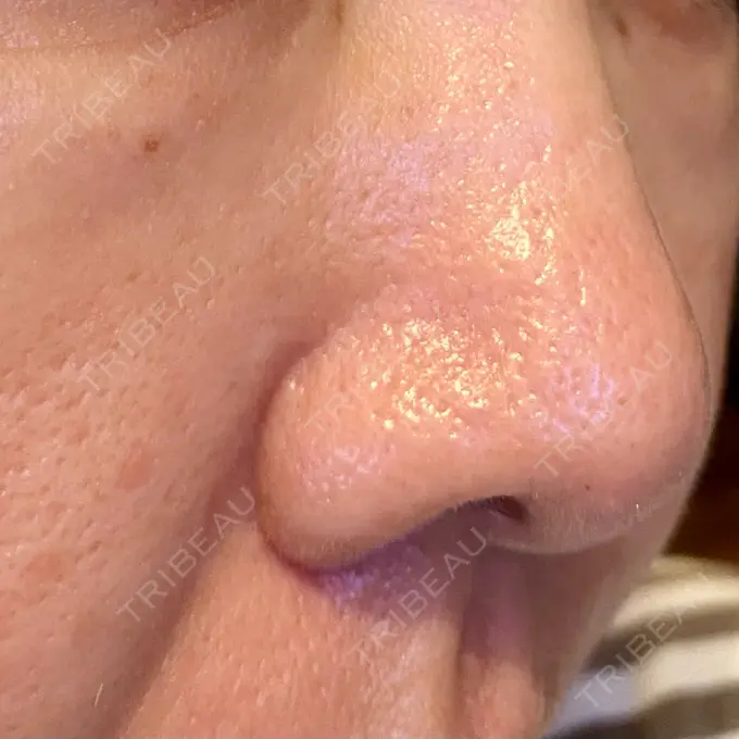 サブシジョン / 肌育注射（ジュベルックなど） / その他（肌） ゆきスキンクリニック 東池袋 BEFORE メイン用