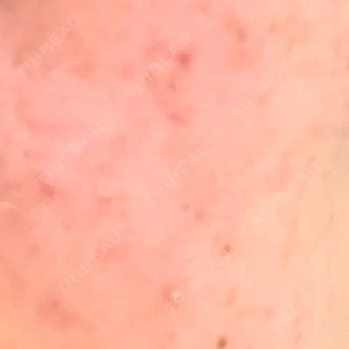 イオン導入 城本クリニック 名古屋院 BEFORE メイン用