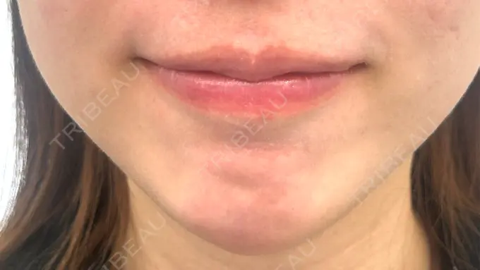 ボトックス（エラ・小顔） / その他 eクリニック 岡山院 BEFORE メイン用