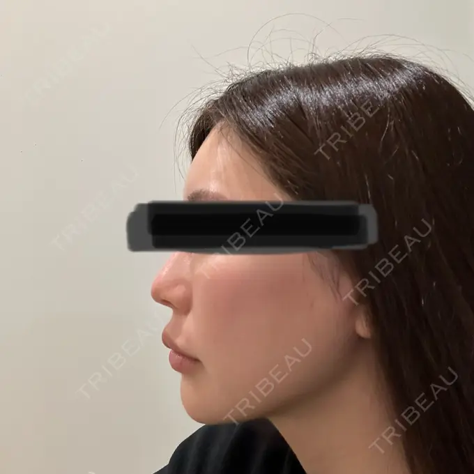 軟骨移植 湯田クリニック 銀座 BEFORE メイン用