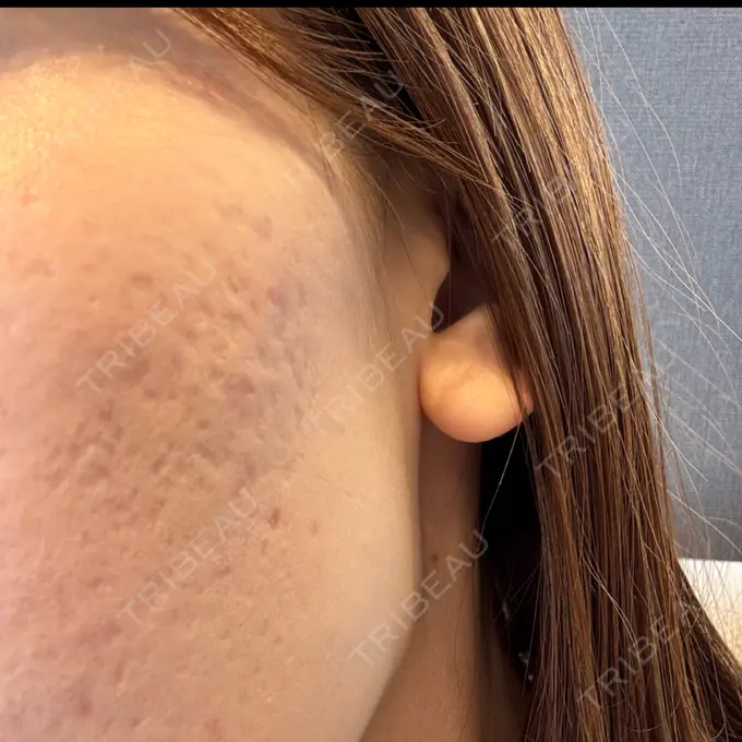 サブシジョン / 肌育注射（ジュベルックなど） 東京シルククリニック 新宿院 BEFORE メイン用