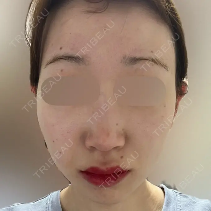 ボトックス（あご） / ボトックス（口角） / マイクロボトックス / ボトックス（額） M'sクリニック【エムズクリニック】 BEFORE メイン用