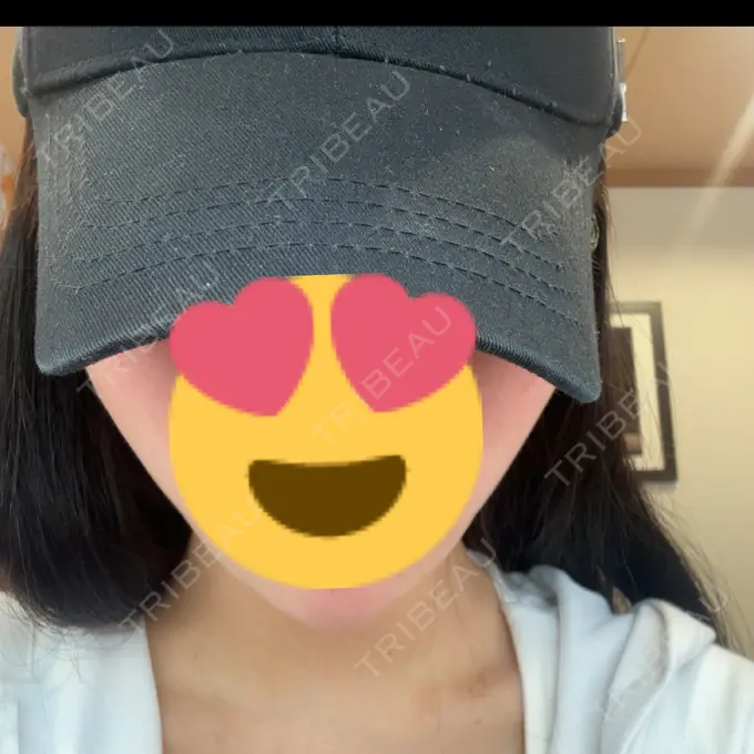 ハイフ（顔） ミニマムスキンクリニック池袋 BEFORE メイン用