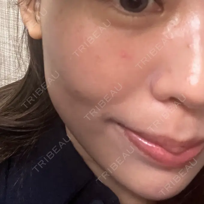 肌育注射（ジュベルックなど） / エレクトロポレーション ハナビューティークリニック BEFORE メイン用