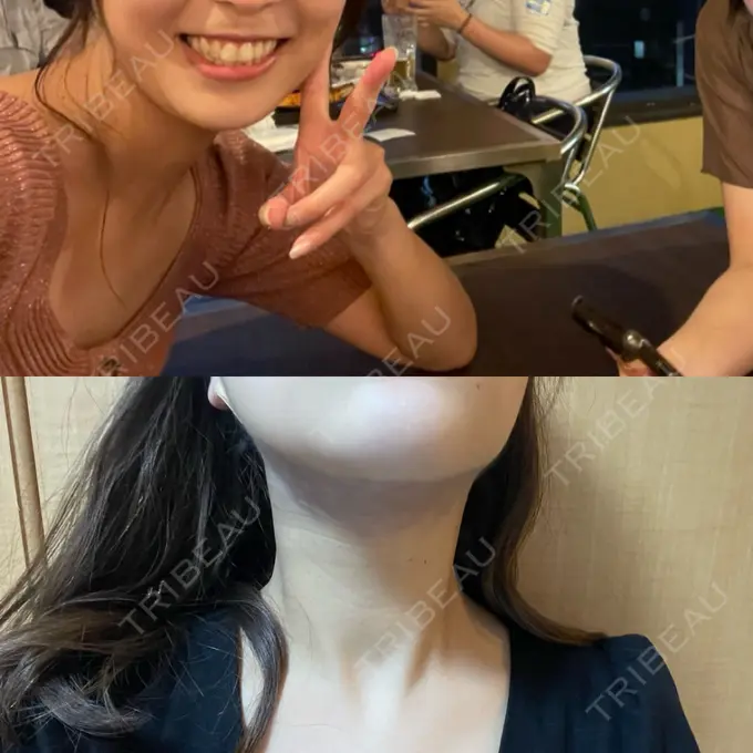 脂肪吸引（顔） eクリニック 福岡院 BEFORE メイン用