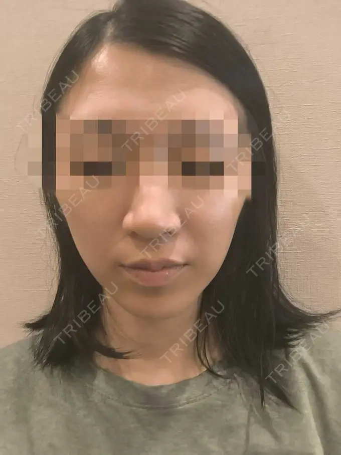 美肌レーザー / シミ取りレーザー / ピコレーザートーニング（美白・肝斑） / YAGレーザー / レーザートーニング（美白・肝斑） / 赤み除去レーザー AI Beauty Clinic （エーアイ美容クリニック） BEFORE メイン用