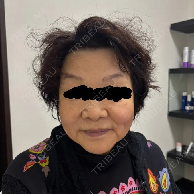 RF（高周波）たるみ治療 共立美容 池袋院 BEFORE メイン用