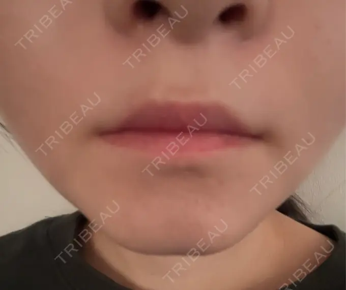 シワ取りボトックス / その他（輪郭） PRISM Beauty Clinic 町田院 BEFORE メイン用