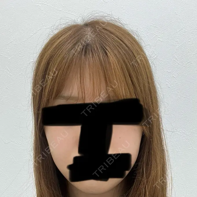 RF（高周波）たるみ治療 大美会クリニック 天王寺院 BEFORE メイン用