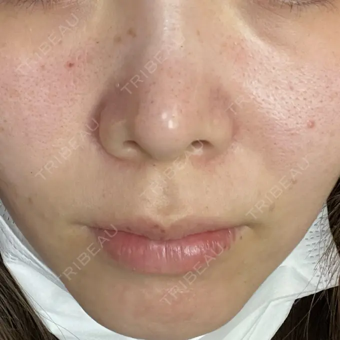 ポテンツァ ARTE SKIN CLINIC 【アルテスキンクリニック】 BEFORE メイン用