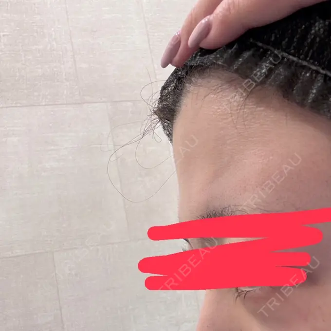 脂肪注入（額） / ボトックス（額） Bloom Delight Clinic BEFORE メイン用