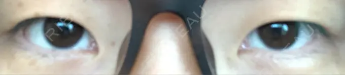 二重埋没 湘南美容クリニック 京都院 BEFORE メイン用