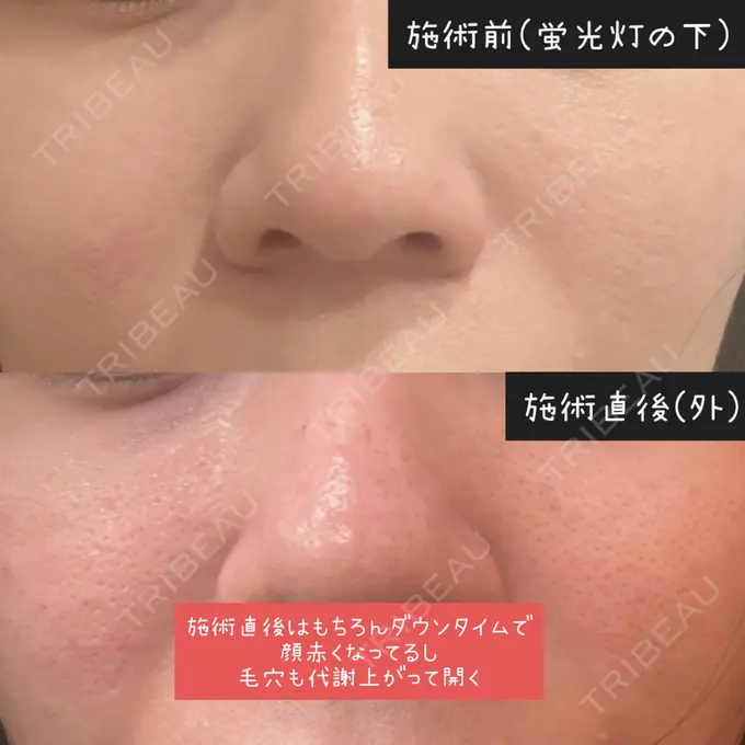 小鼻縮小（非切開） / ワキ汗治療（ボトックス） / ボトックス（目尻） / ボトックス（人中） / 肌育注射（ジュベルックなど） SUNMELIA SKIN CLINIC BEFORE メイン用