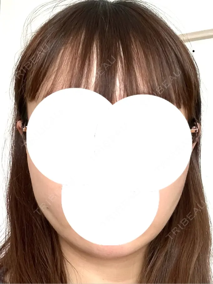 糸リフト / バッカルファット除去 / 脂肪吸引（顔） / ヒアルロン酸注入（あご） eクリニック 福岡院 BEFORE メイン用