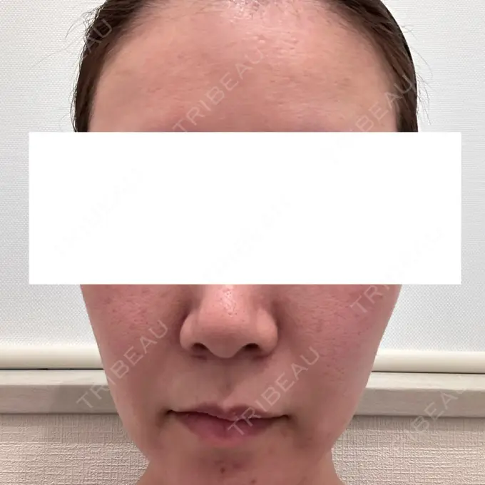 ダーマペン DAILY SKIN CLINIC 福岡院 BEFORE メイン用