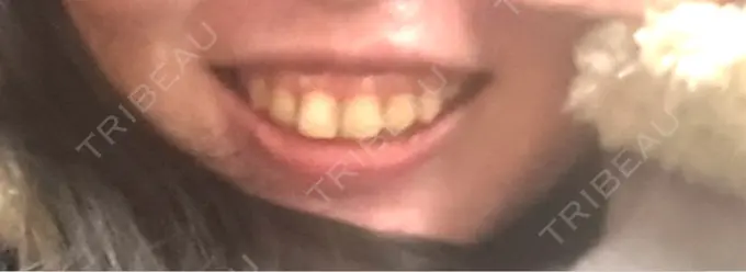 ボトックス（ガミースマイル） 形成外科と美容外科のクリニック池袋 BEFORE メイン用