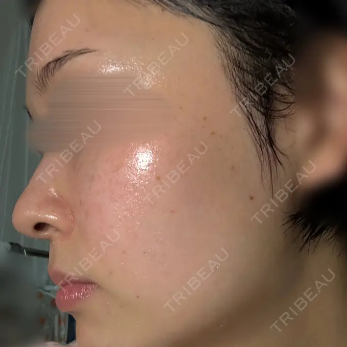 エレクトロポレーション Kobe OCEANS Clinic BEFORE メイン用