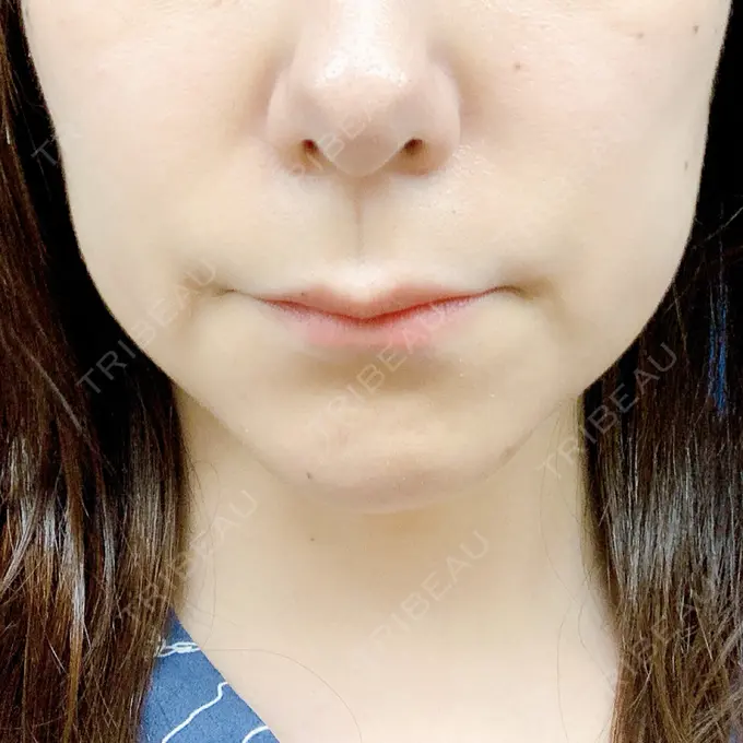 ボトックス（エラ・小顔） / マイクロボトックス / ボトックス（首） / ボトックス（人中） 筋肉・美容クリニック BEFORE メイン用