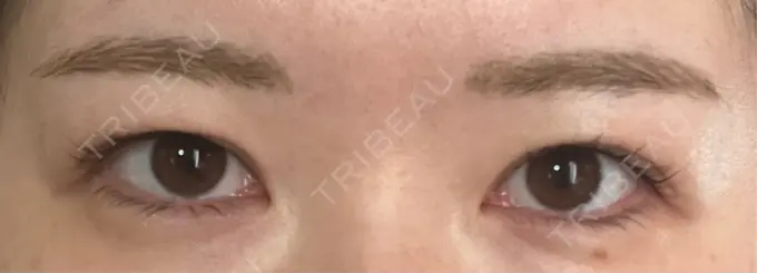 眉下切開 / ボトックス（眉間） / ボトックス（額） 銀座リシェスクリニック BEFORE メイン用