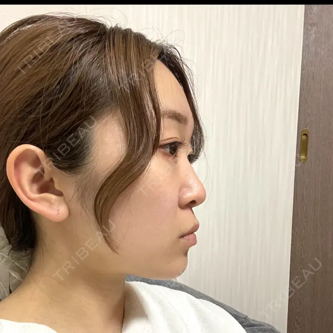 鼻尖形成（切開） / 小鼻縮小（切開） / 骨切幅寄せ / ワシ鼻修正・ハンプ切除 id（アイディ）美容外科 BEFORE メイン用