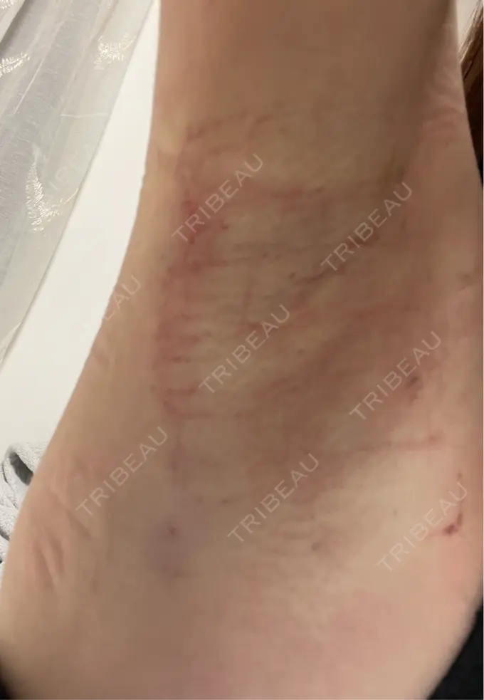 ワキ汗治療（レーザー） ルラ美容クリニック 渋谷本院 BEFORE メイン用