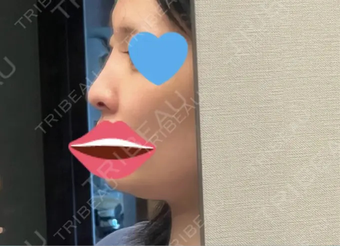 軟骨移植 吉祥寺アイビークリニック BEFORE メイン用