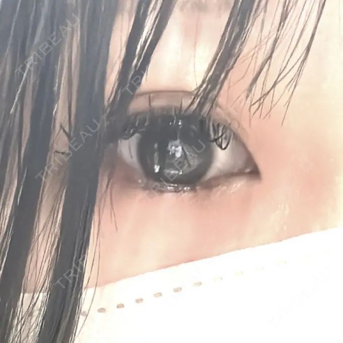 ヒアルロン酸注入（涙袋） ルヴィクリニック イオンドーム前院 BEFORE メイン用