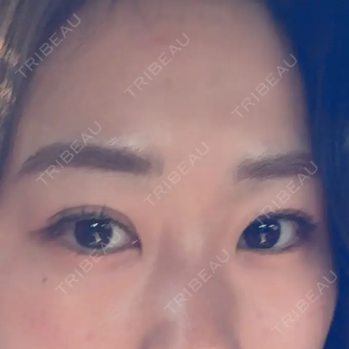 二重埋没 湘南美容クリニック 大阪四ツ橋院 BEFORE メイン用