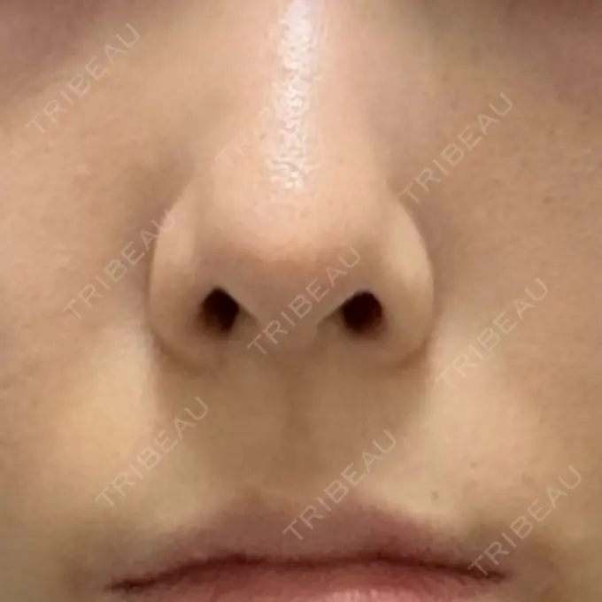 鼻孔縁下降 / その他（鼻） 聖心美容クリニック 銀座院 BEFORE メイン用