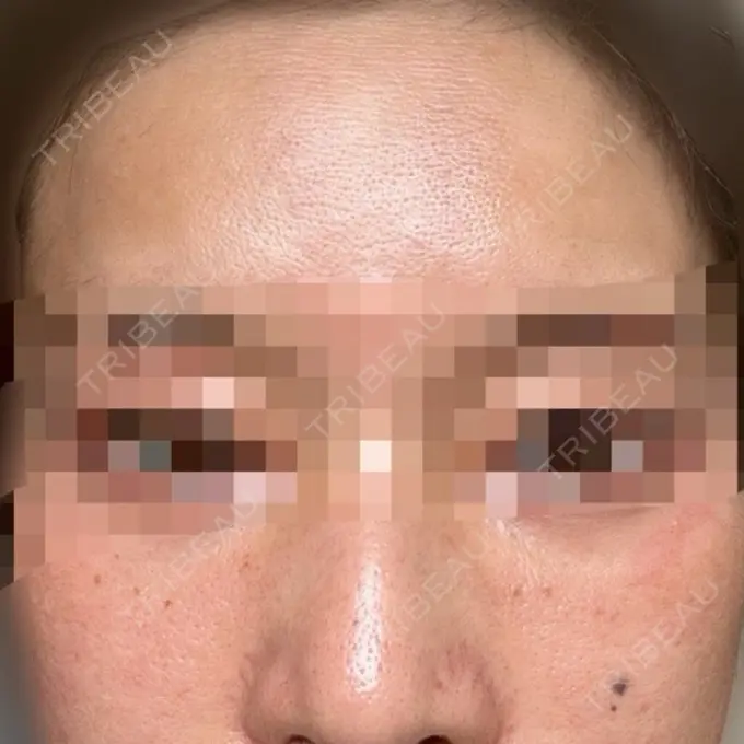 肌育注射（ジュベルックなど） ハナビューティークリニック BEFORE メイン用