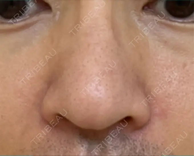 脂肪溶解注射（顔） / その他（鼻） TCB東京中央美容外科 広島院 BEFORE メイン用