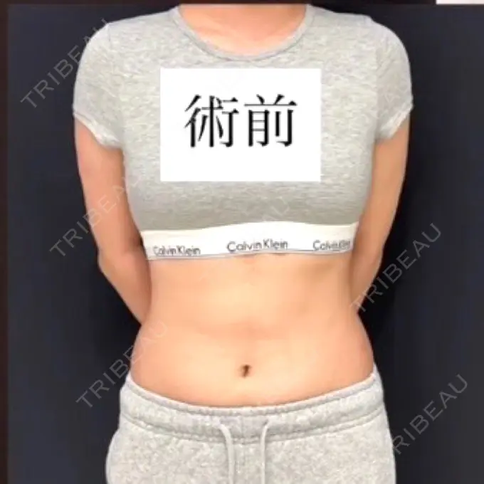脂肪吸引（お腹） / 医療痩身（お腹） 4Dクリニック BEFORE メイン用