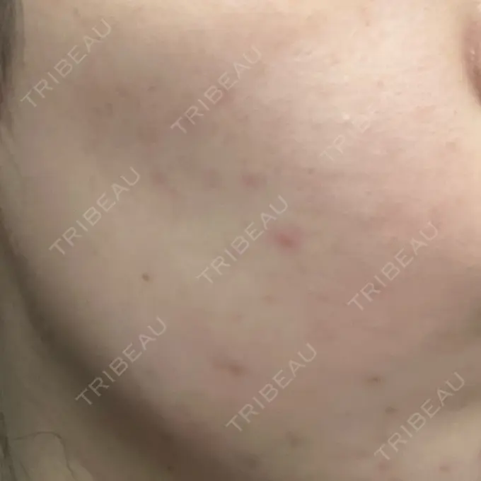 エレクトロポレーション SK新宿歌舞伎町美容外科・歯科 BEFORE メイン用